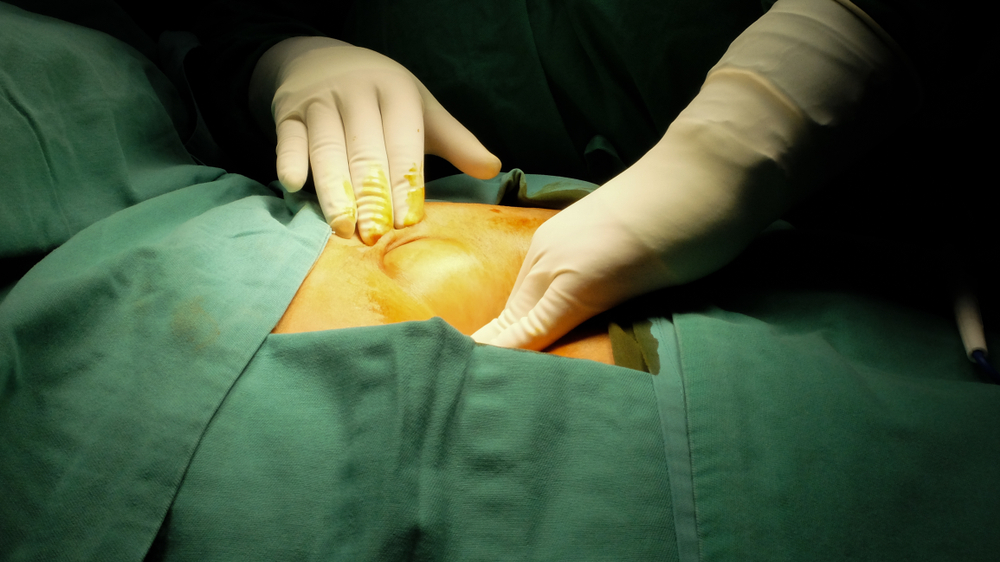 hernia surgery