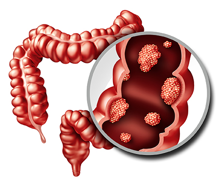 Colorectal Cancer in El Paso